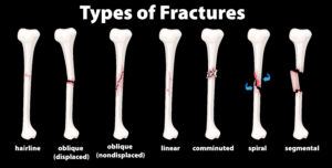 Fracture treatement