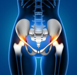 Hip Joint Replacement