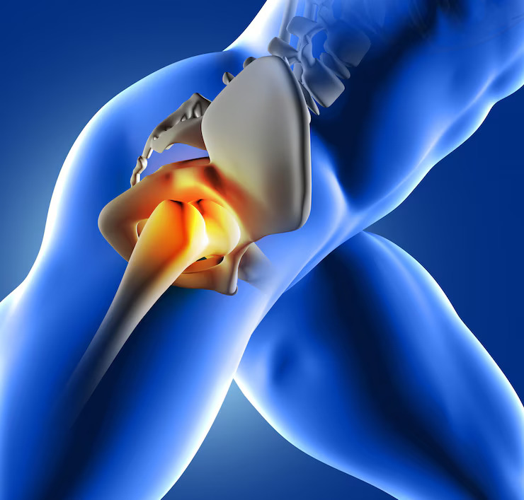 Hip Joint Replacement: A Complete guide