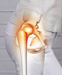 Recovery Timeline for Hip Joint Replacement