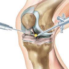 What to Expect During an Arthroscopy Procedure?