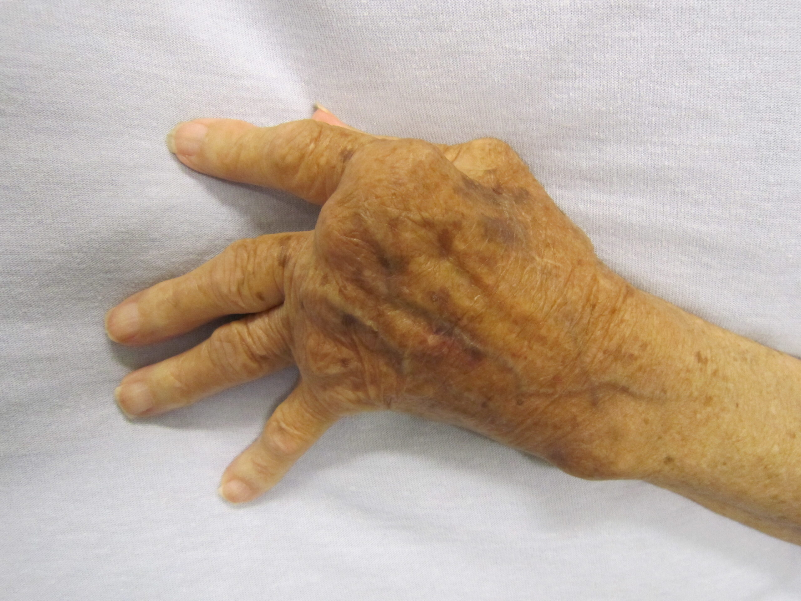 Best Treatment for Arthritis: Exploring Common Options